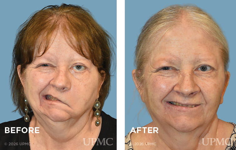 Right facial nerve exploration and repair, 5-7 nerve transfer for flaccid facial paralysis due to penetrating facial injury